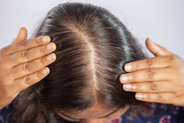 Hair loss